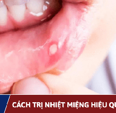 Cách Trị Nhiệt Miệng Nhanh Chóng, Hiệu Quả Tại Nhà